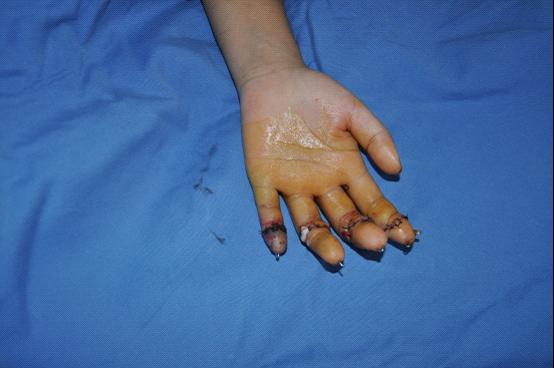 八指离断争秒接 重获新生患者笑|台州市博爱医院|路桥博爱医院|上海长海医院台州分院