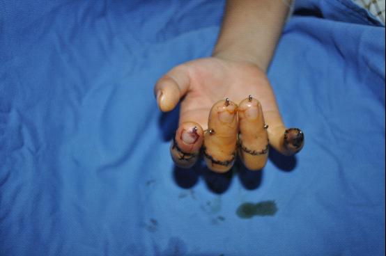 八指离断争秒接 重获新生患者笑|台州市博爱医院|路桥博爱医院|上海长海医院台州分院