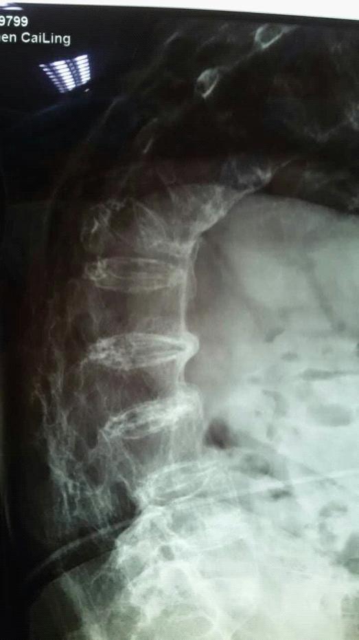 特殊病人行特别手术——九十度驼背老奶奶解除病痛恢复良好|台州市博爱医院|路桥博爱医院