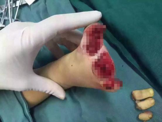 三岁幼儿多趾离断 白衣天使妙手回春|台州市博爱医院|路桥博爱医院