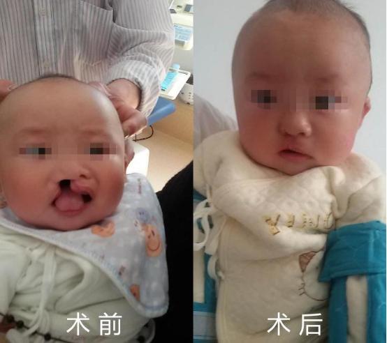 修复先天重度唇腭裂 婴儿面容焕然一新|台州市博爱医院口腔科|整形美容科|袁会宁|孙菊妹