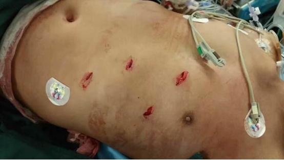 四川男子被捅数刀心脏破裂 博爱专家连夜“补心”救回一命|台州市博爱医院