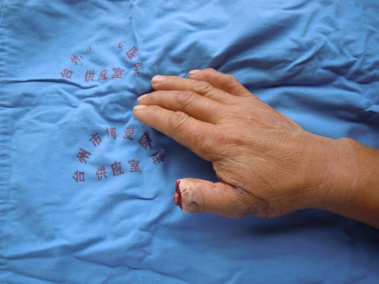 拆线后，他竖起“大拇指”给医生点赞|台州市博爱医院