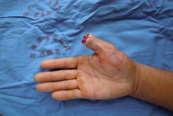 拆线后，他竖起“大拇指”给医生点赞|台州市博爱医院