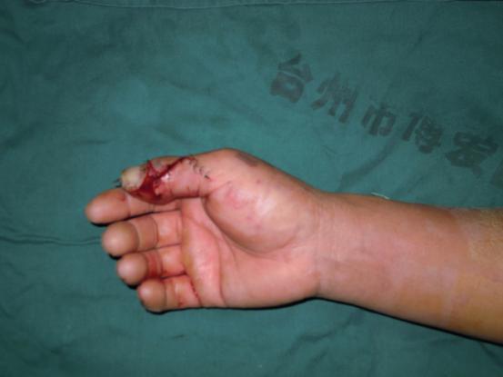 拆线后，他竖起“大拇指”给医生点赞|台州市博爱医院