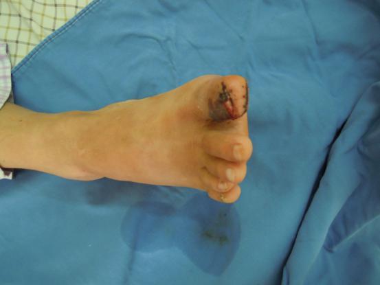 拆线后，他竖起“大拇指”给医生点赞|台州市博爱医院