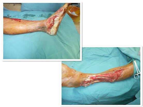 化学烧伤足踝部 精湛医术保双腿|台州市博爱医院骨科