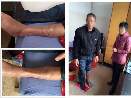 化学烧伤足踝部 精湛医术保双腿|台州市博爱医院骨科