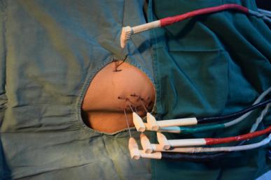 台州市博爱医院开展全市首例氩氦刀冷冻消融术|路桥博爱医院