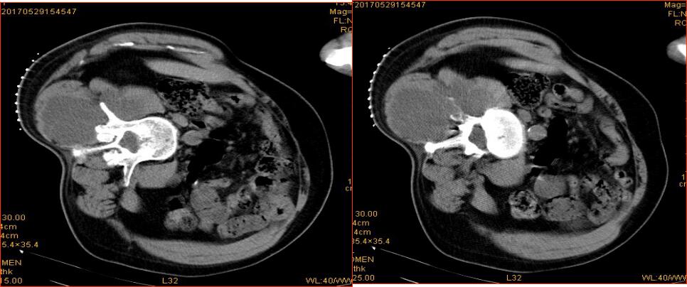 台州市博爱医院开展全市首例氩氦刀冷冻消融术|路桥博爱医院