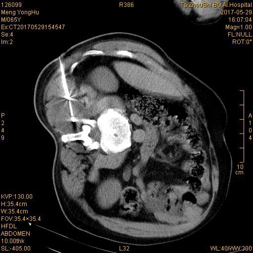 台州市博爱医院开展全市首例氩氦刀冷冻消融术|路桥博爱医院