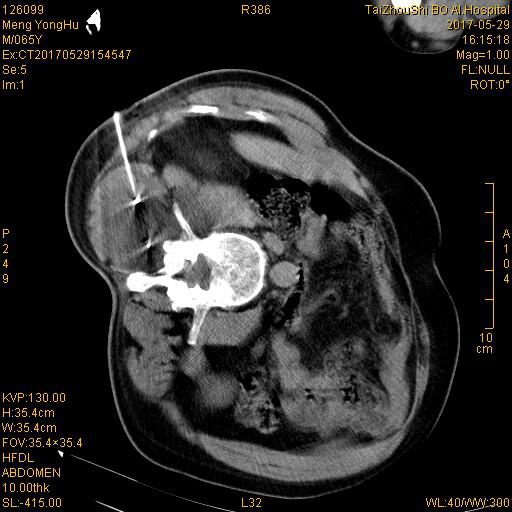 台州市博爱医院开展全市首例氩氦刀冷冻消融术|路桥博爱医院