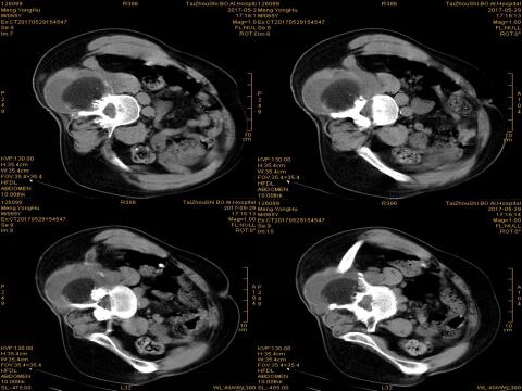 台州市博爱医院开展全市首例氩氦刀冷冻消融术|路桥博爱医院