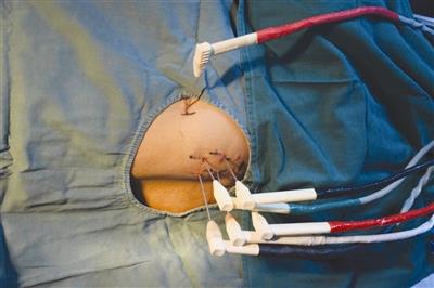 博爱医院开展全市首例氩氦刀冷冻消融术[今日路桥]