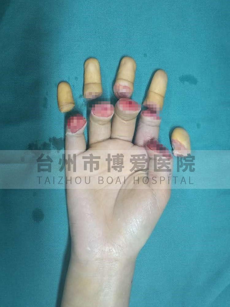 台州市博爱医院孙晟君术前掌侧