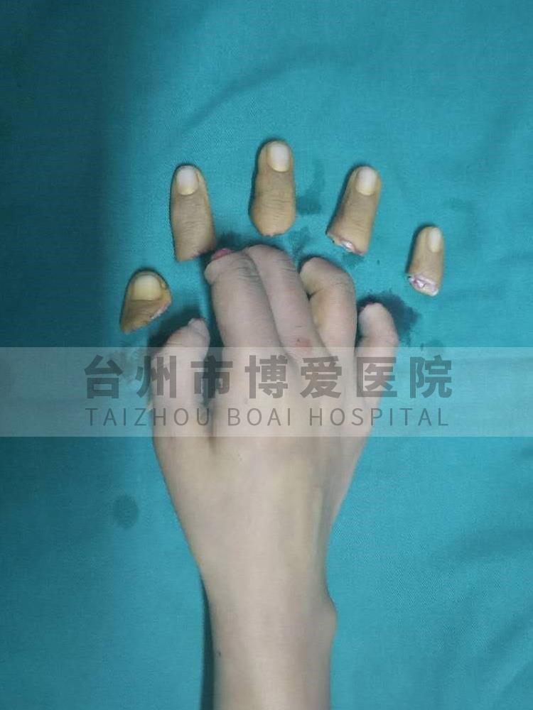 台州市博爱医院孙晟君术前背侧