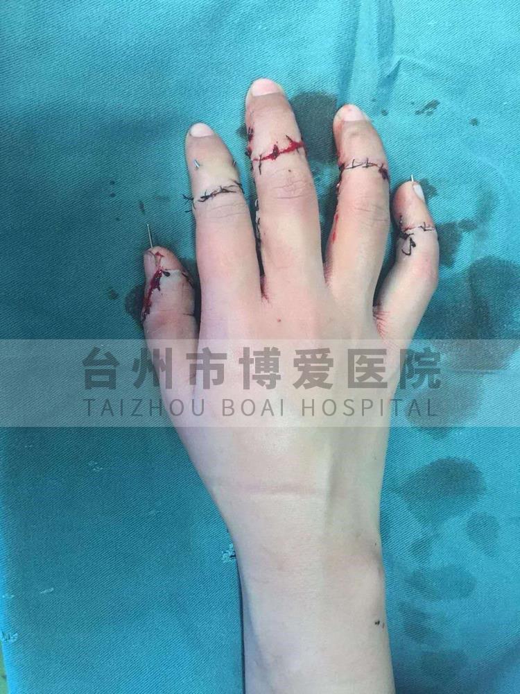 台州市博爱医院孙晟君术后背侧