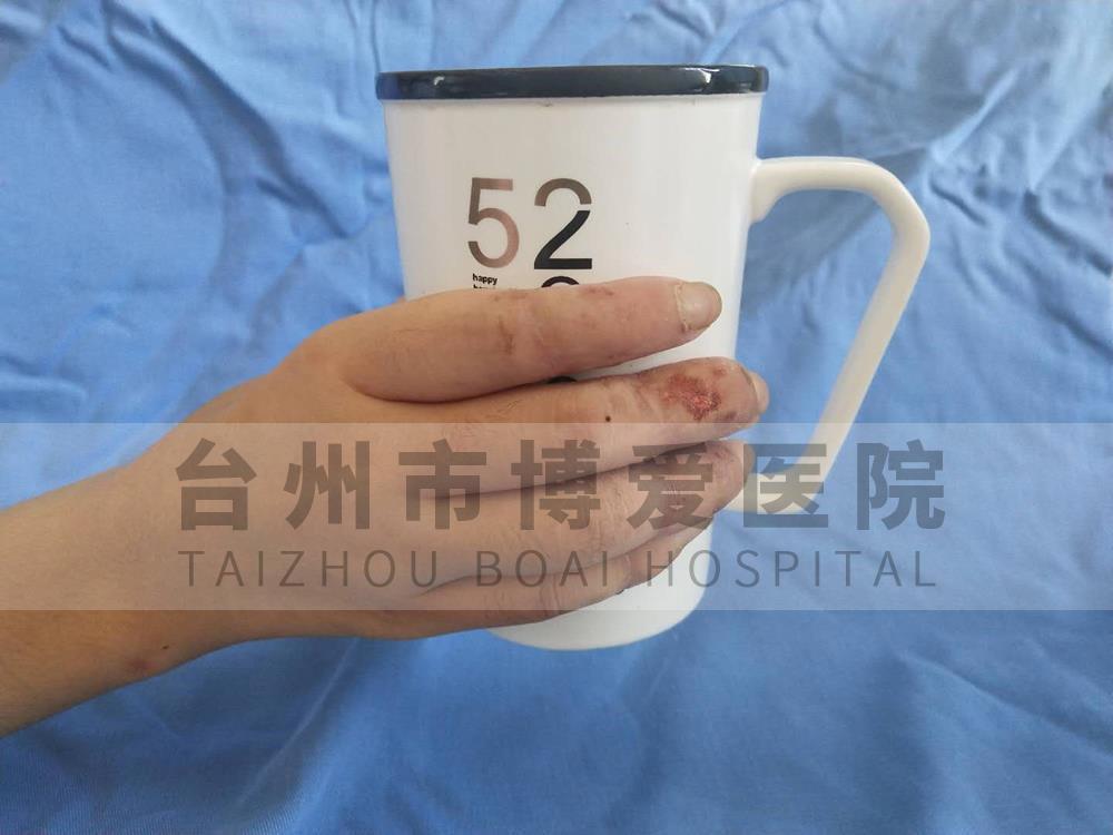 台州市博爱医院孙晟君术后背侧三月功能照