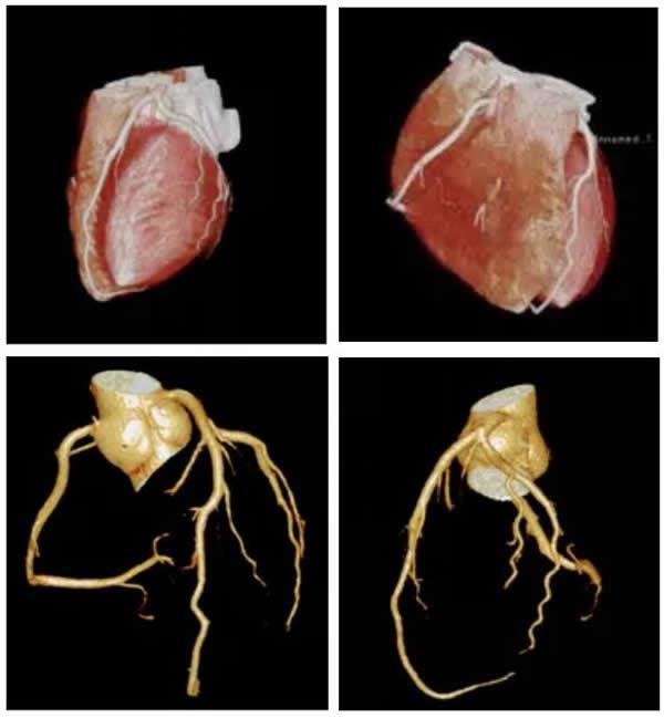 为“心”护航，路桥区首例心脏冠状动脉成像|台州市博爱医院影像中心|路桥区医共体影像医学分中心