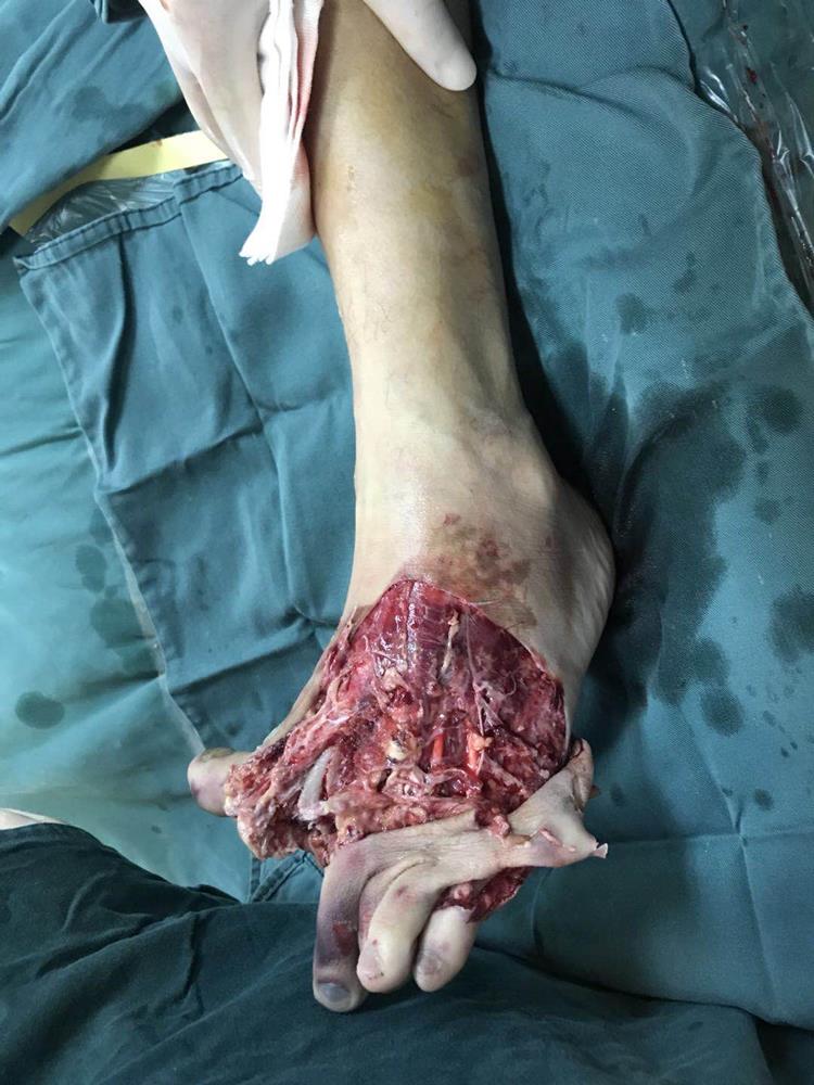 五趾再植获成功 患者感恩送锦旗|台州市博爱医院