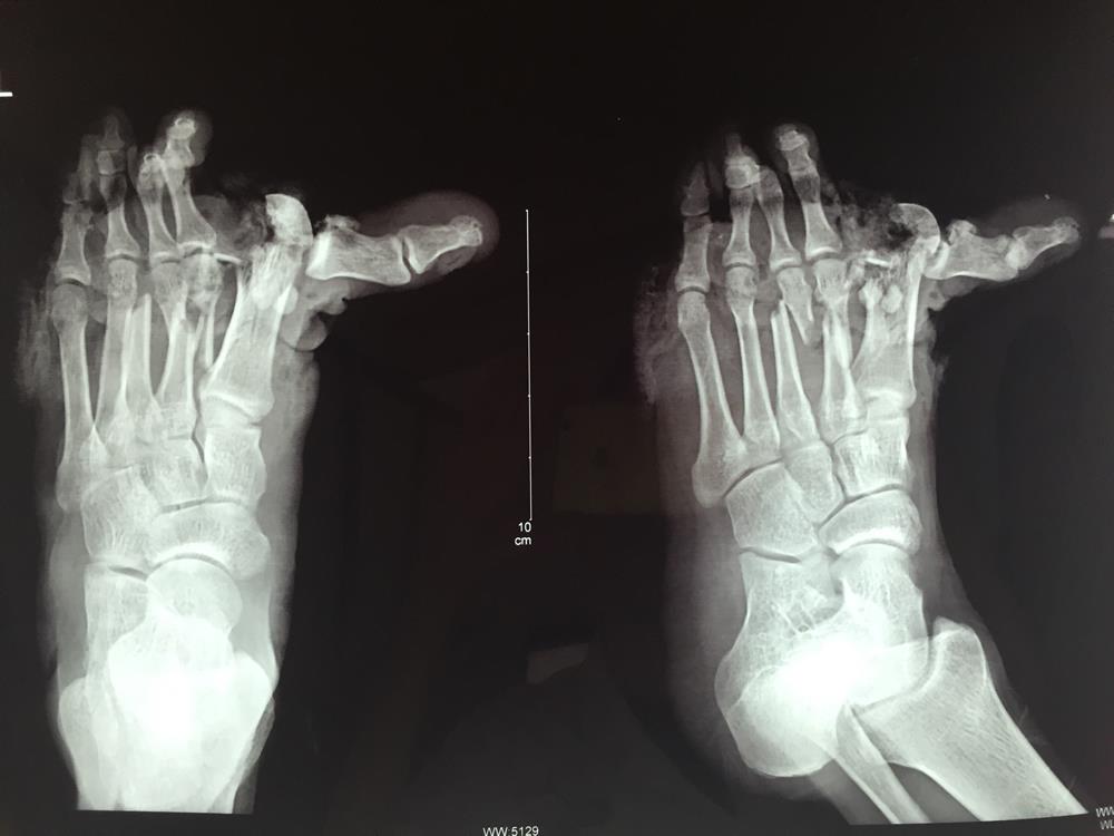 五趾再植获成功 患者感恩送锦旗|台州市博爱医院