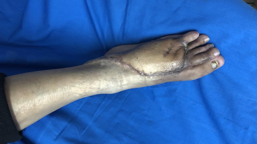 五趾再植获成功 患者感恩送锦旗|台州市博爱医院