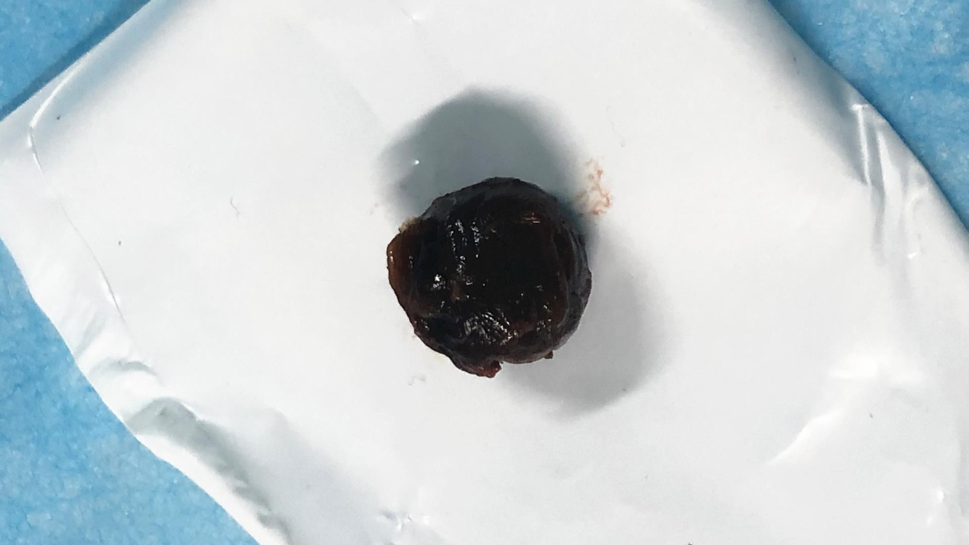 气管异物，难以描述的心痛！台州市博爱医院成功抢救一例气管异物的患儿