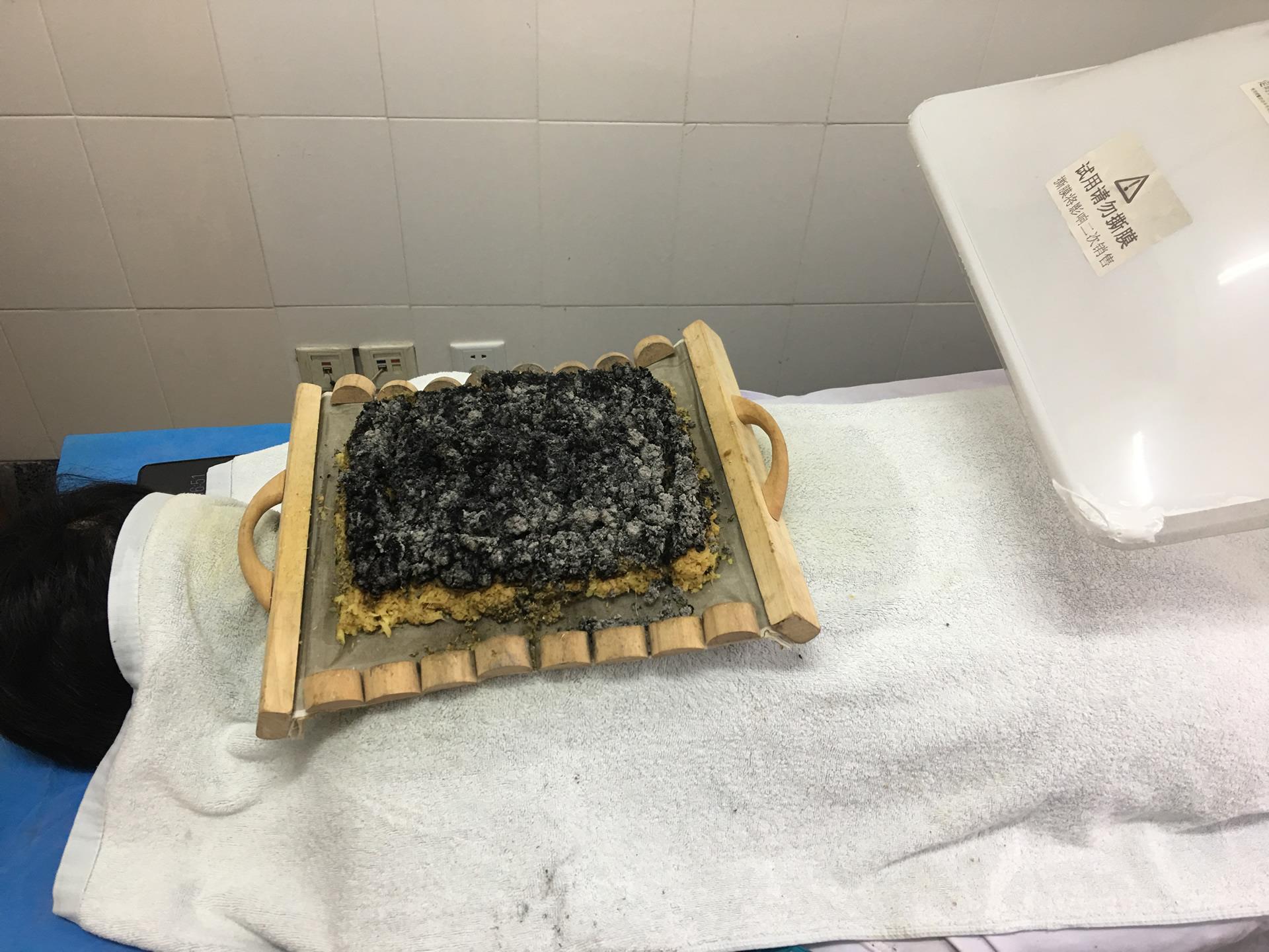 “灸中之皇”——督脉灸来了|台州市博爱医院