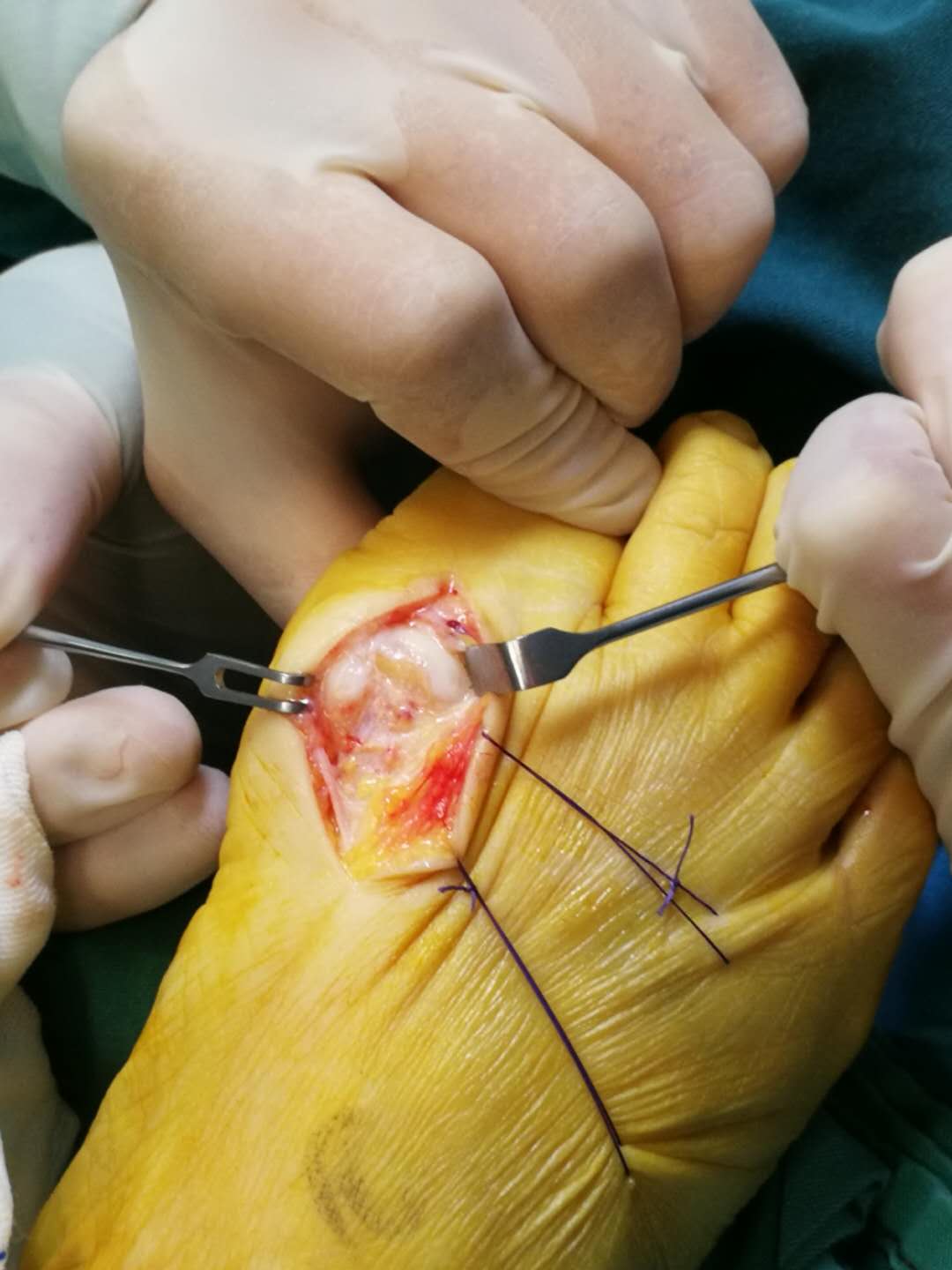 每天行走在刀尖上的“人鱼公主”，疼痛居然是因为脚上长出了一颗“心”！