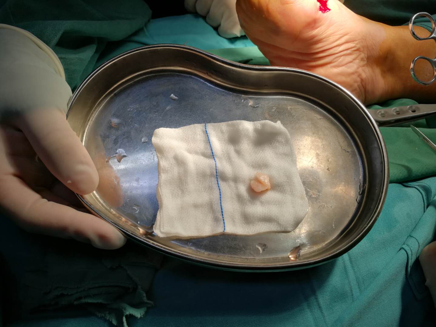 每天行走在刀尖上的“人鱼公主”，疼痛居然是因为脚上长出了一颗“心”！