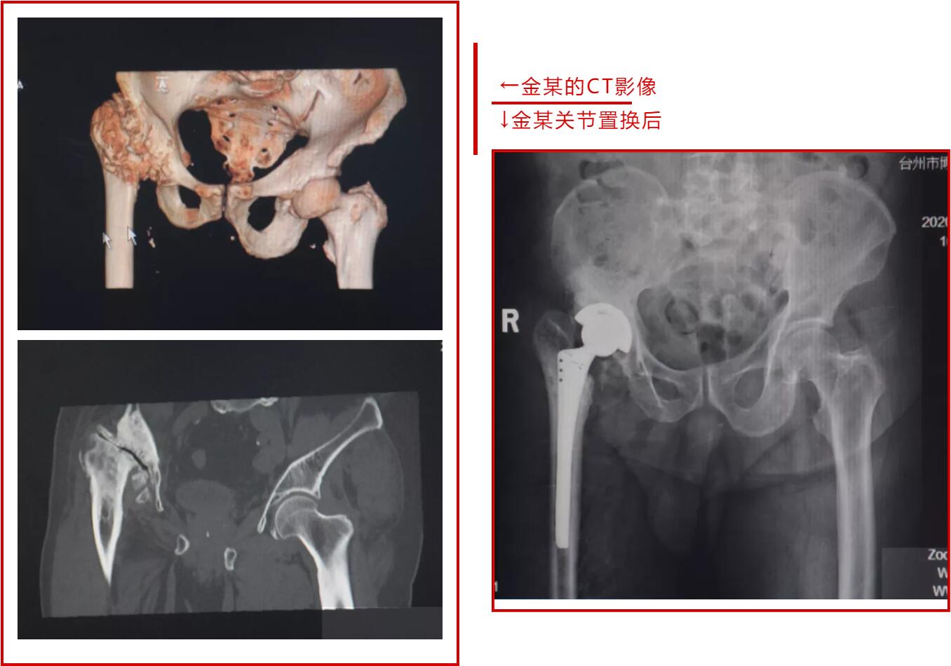 六十多年后，我终于找到了你——藏在腿里的秘密|台州市博爱医院