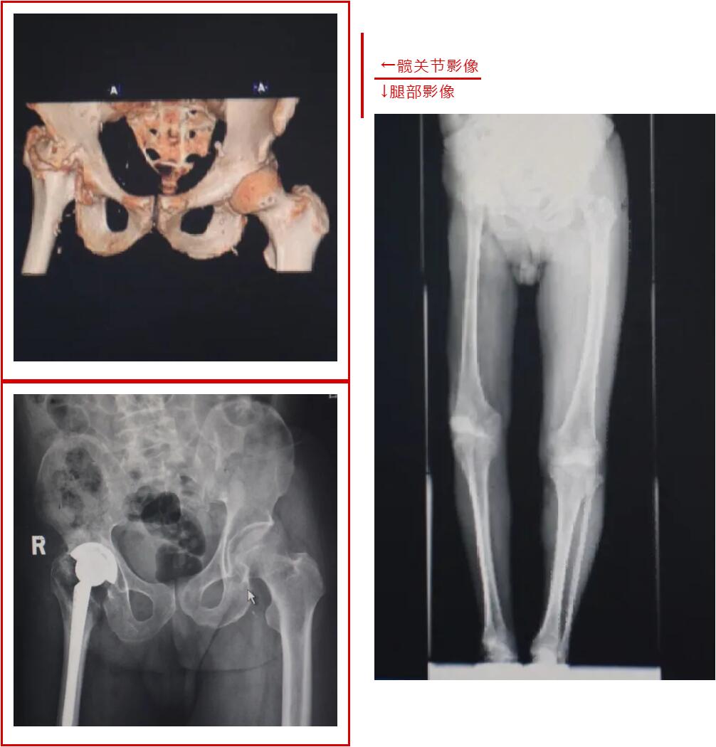六十多年后，我终于找到了你——藏在腿里的秘密|台州市博爱医院