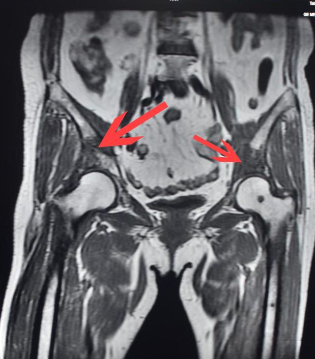体内骨头被这东西“吃”掉了一大块！持续性疼痛，一定要尽早就医！