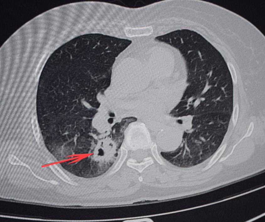 体内骨头被这东西“吃”掉了一大块！持续性疼痛，一定要尽早就医！