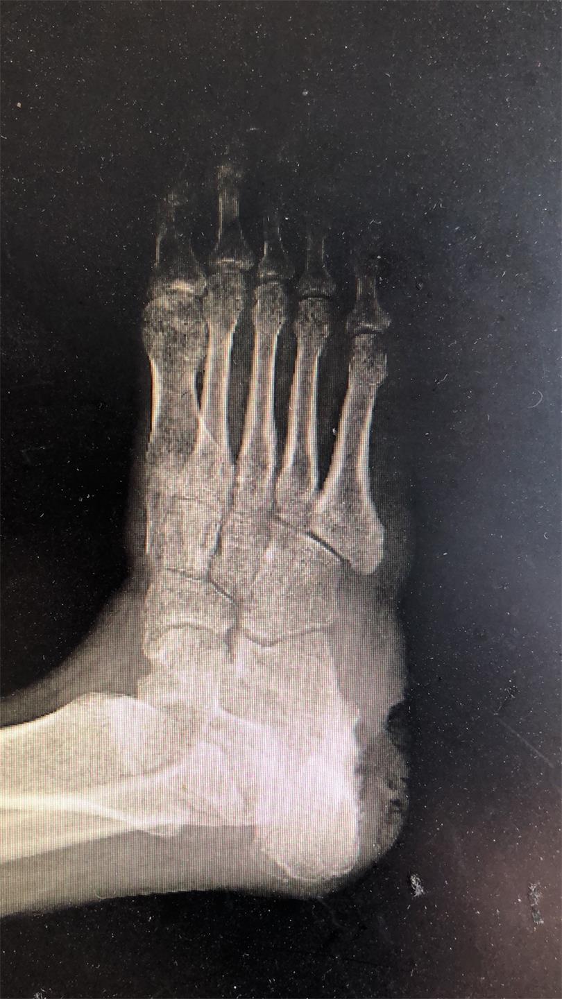 脚疼了三十多年，疼痛一直迁延不愈，要警惕！|台州市博爱医院