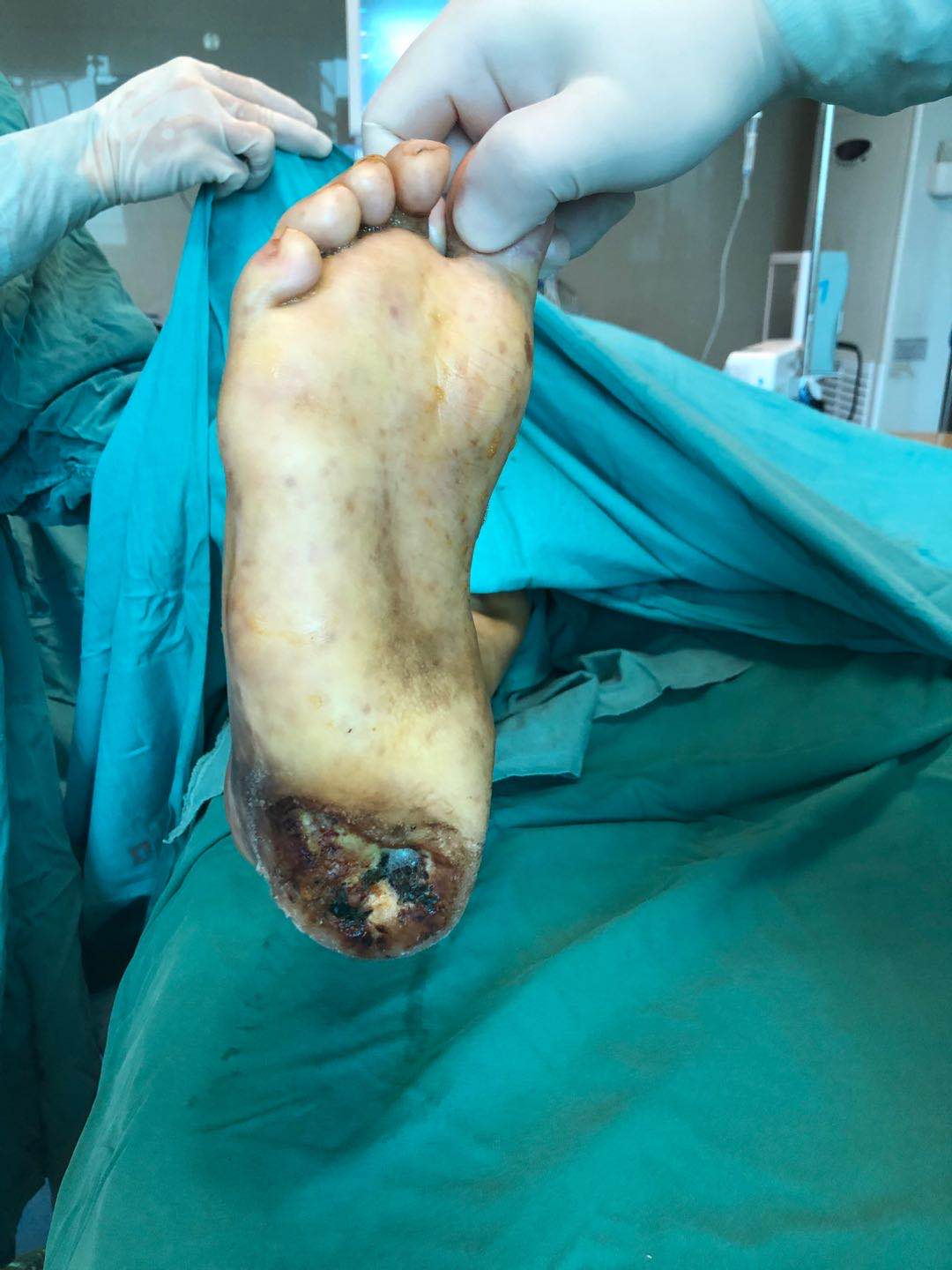 脚疼了三十多年，疼痛一直迁延不愈，要警惕！|台州市博爱医院