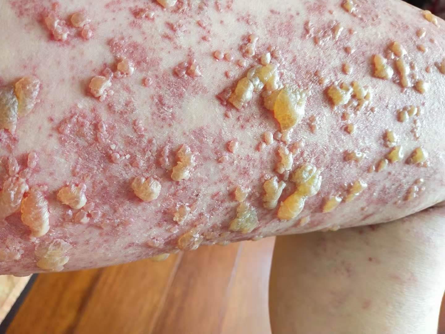 马赛克都遮不住的疤丨被疼痛科医生盯上的她，最后怎么样了？