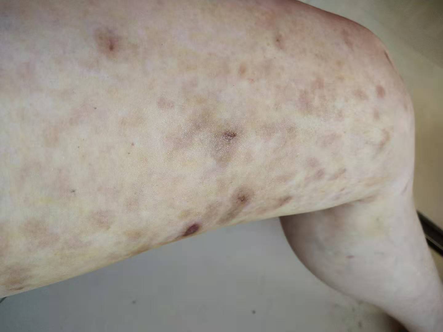 马赛克都遮不住的疤丨被疼痛科医生盯上的她，最后怎么样了？