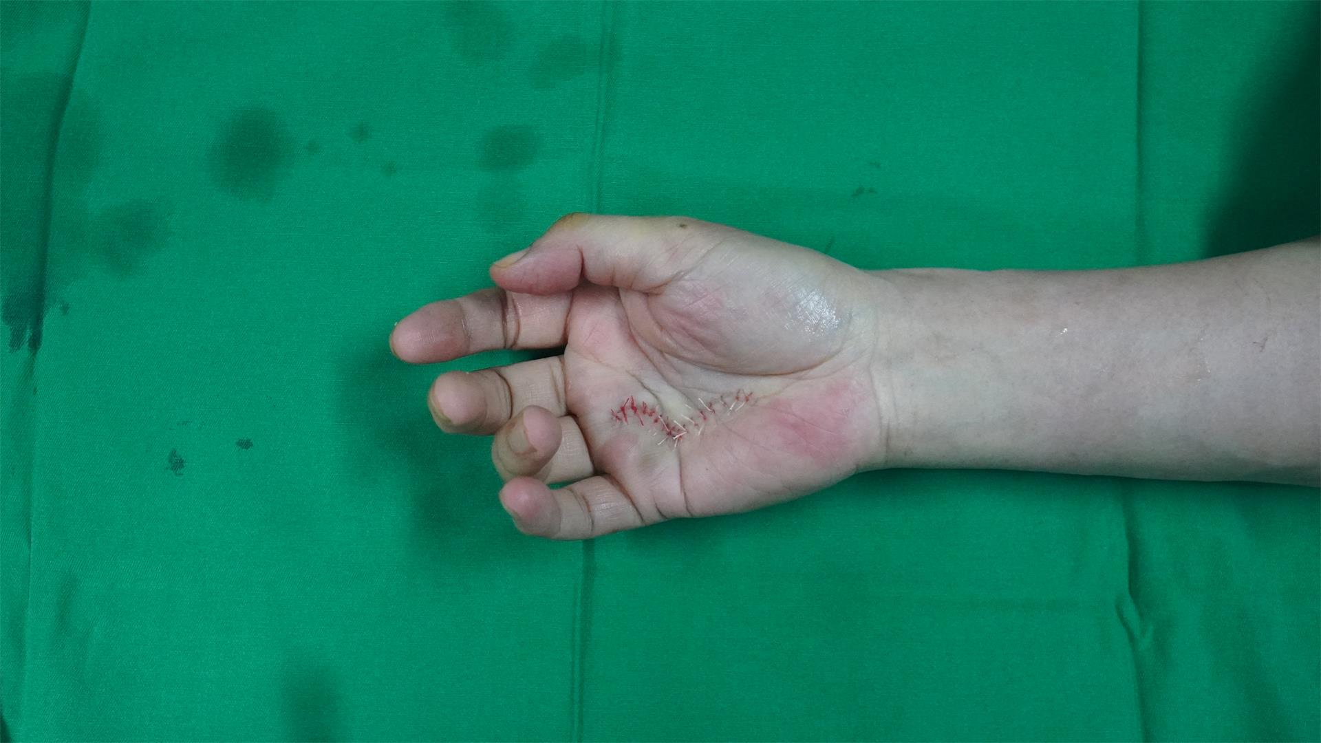 人到中年，突然练就了绝世神功“铁砂掌”，他为什么不开心？|台州博爱医院医共体