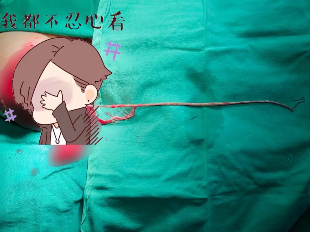 多学科会诊，为失去右臂生命垂危的他保驾护航