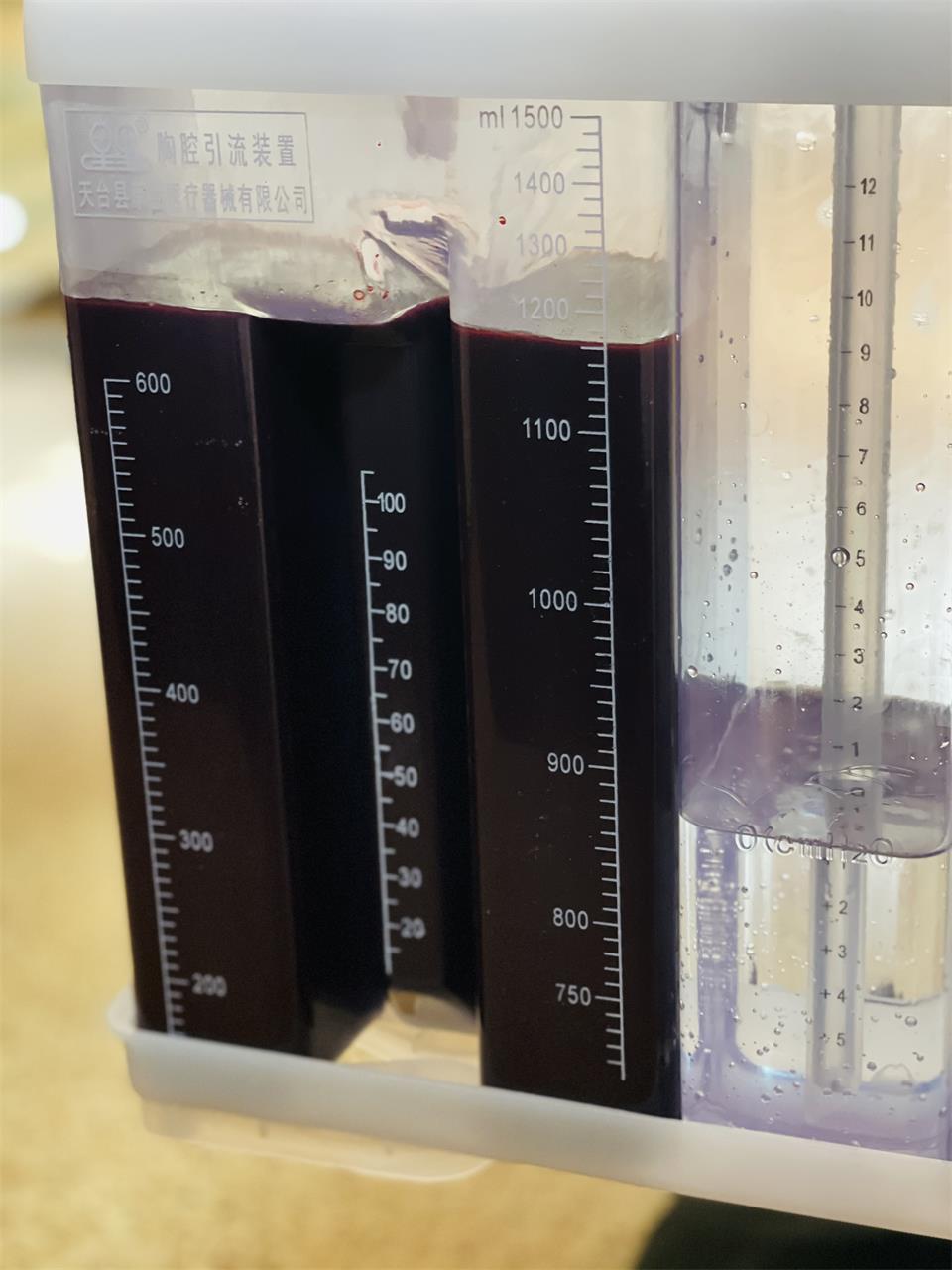 多学科会诊，为失去右臂生命垂危的他保驾护航