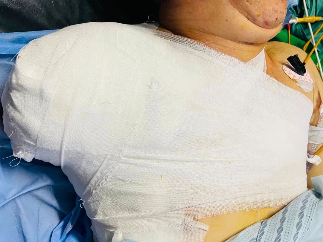 多学科会诊，为失去右臂生命垂危的他保驾护航